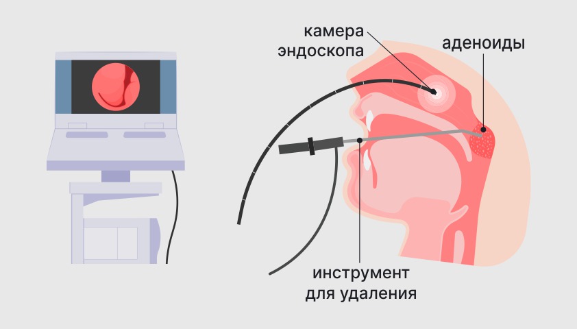 Альвеолит - что это, причины и лечение