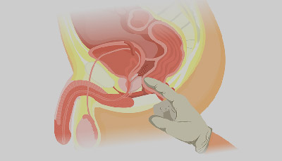 Исследование простаты пальцем через прямую кишку