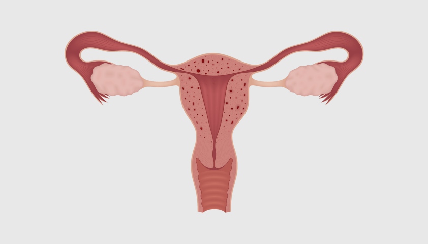 Аденомиоз - что это такое у женщин, симптомы, причины, лечение