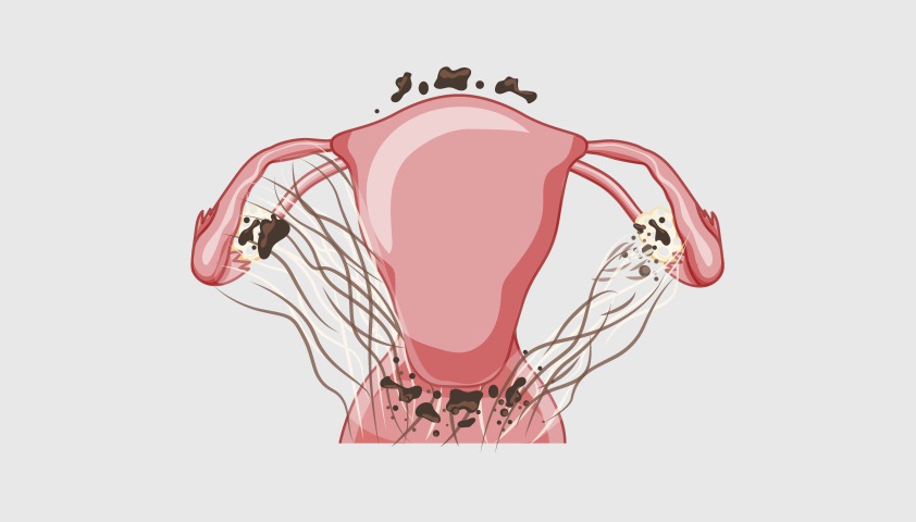 Аденомиоз - что это такое у женщин, симптомы, причины, лечение