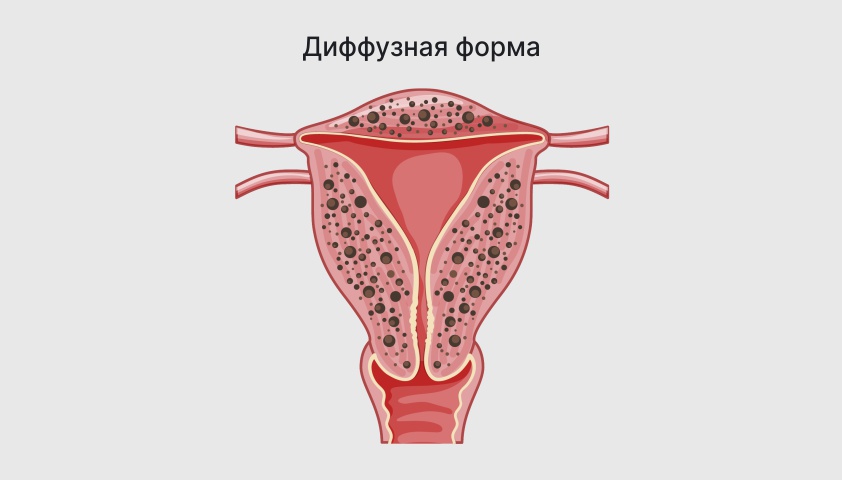 Розацеа (пятна красные на лице) — симптомы, причины и лечение