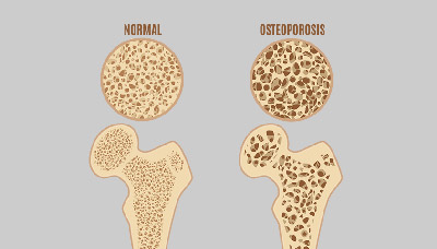 Остеопороз