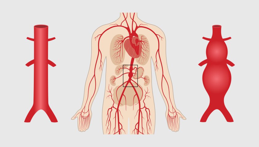 Иллюстрация аневризмы аорты