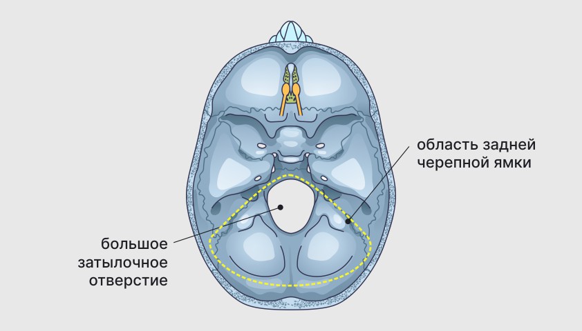 Аномалия Арнольда — Киари - что это такое