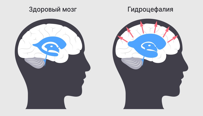 Аномалия Арнольда — Киари - что это такое