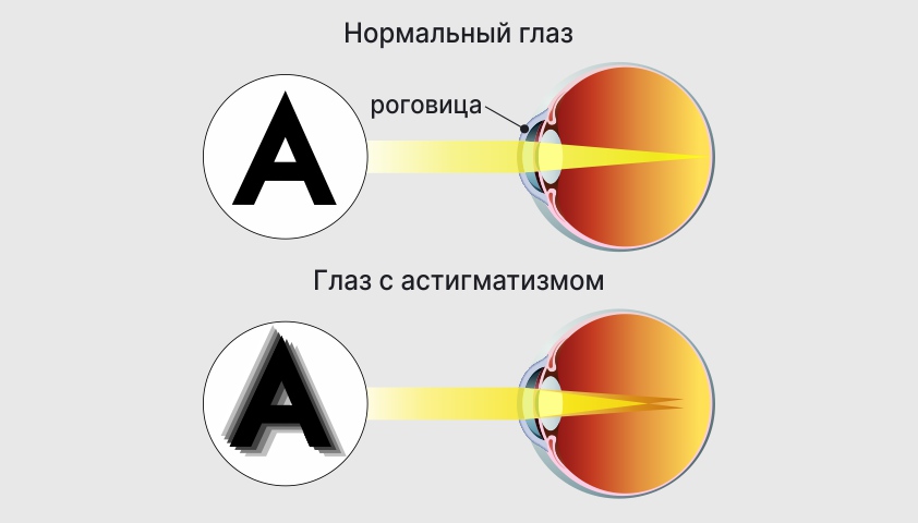 Астигматизм