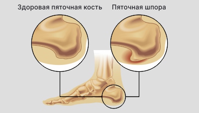 Пяточная шпора