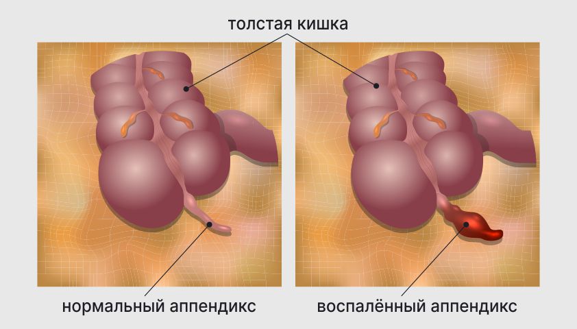 Аппендикс