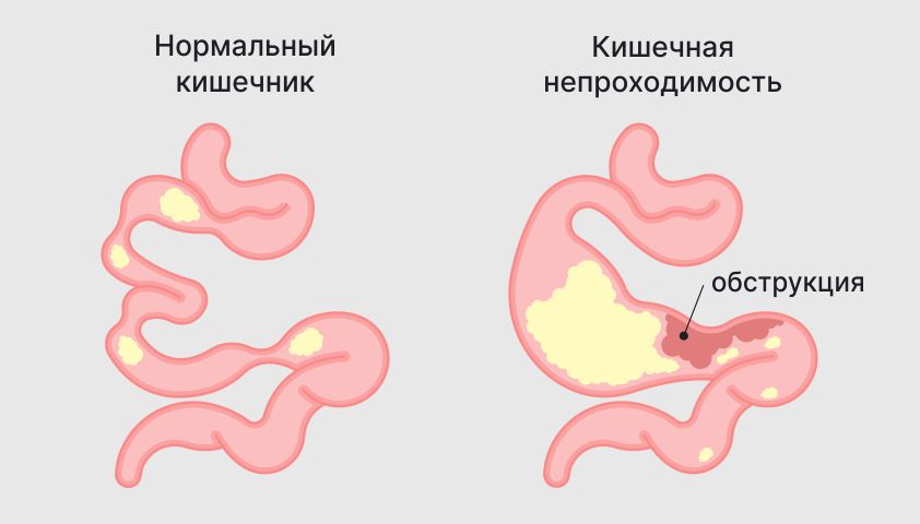 Колит - что это, симптомы и лечение воспаления кишечника