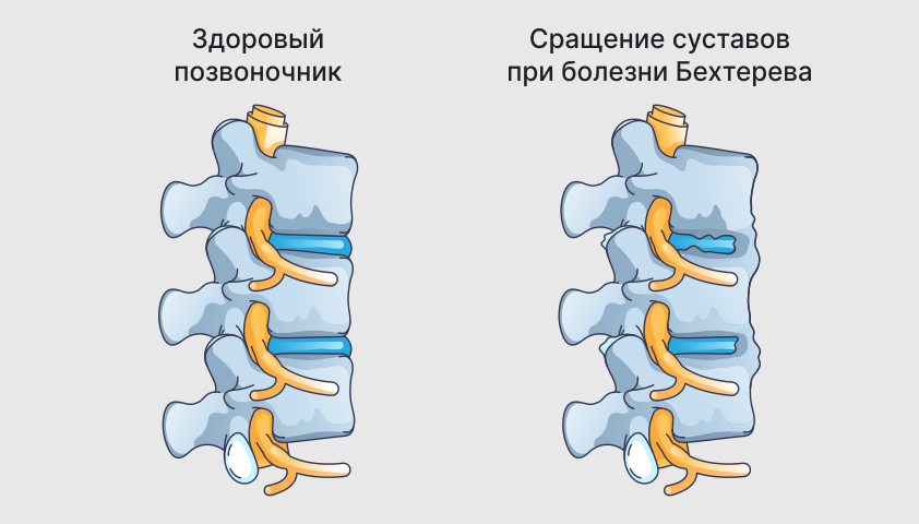 Болезнь Бехтерева (анкилозирующий спондилоартрит) у женщин и мужчин — симптомы и лечение