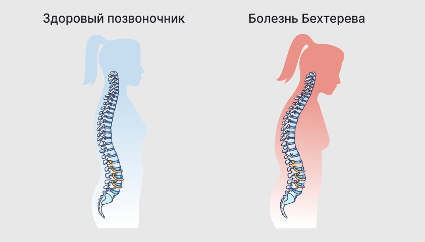 Болезнь Бехтерева (анкилозирующий спондилоартрит) у женщин и мужчин — симптомы и лечение