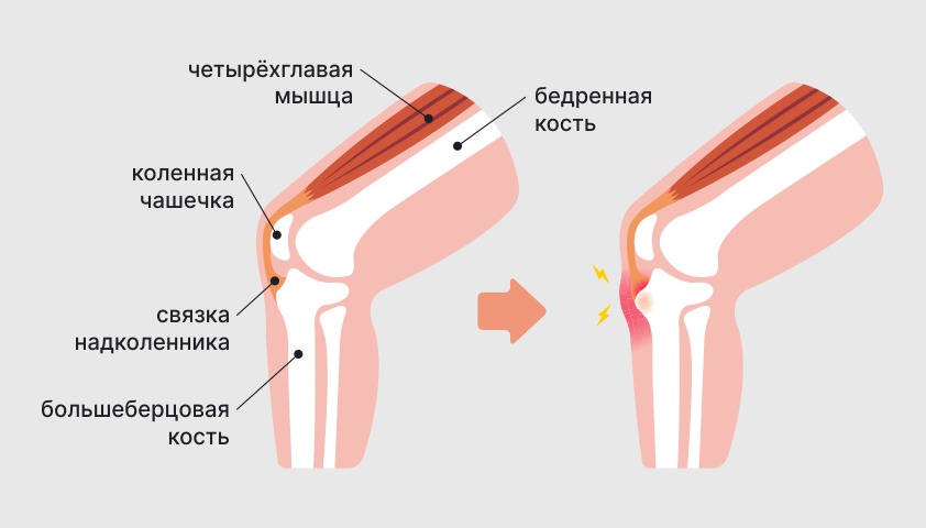 Болезнь Осгуда — Шлаттера: что это, причины, симптомы, диагностика и лечение