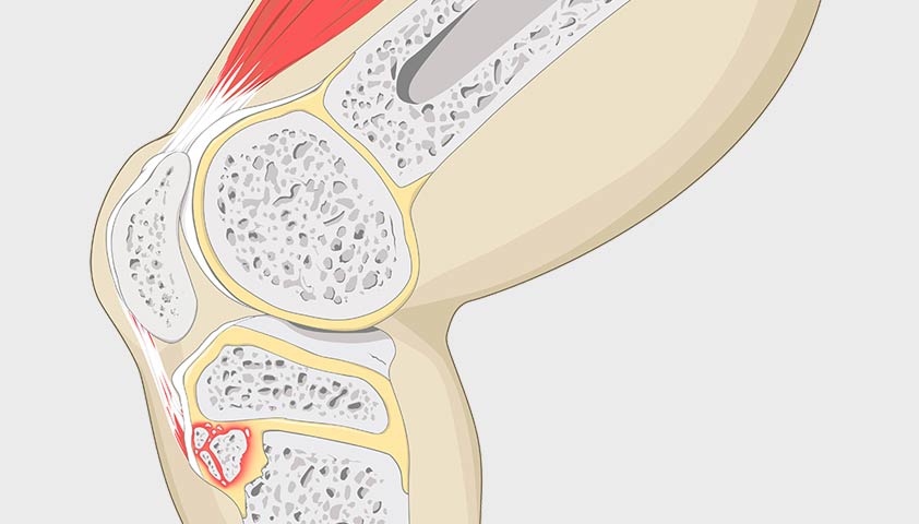 Болезнь Осгуда — Шлаттера: что это, причины, симптомы, диагностика и лечение
