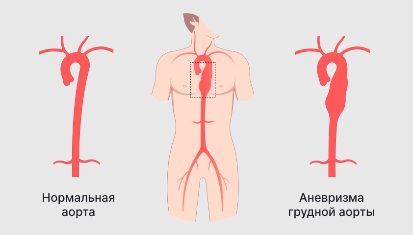 Аневризма1