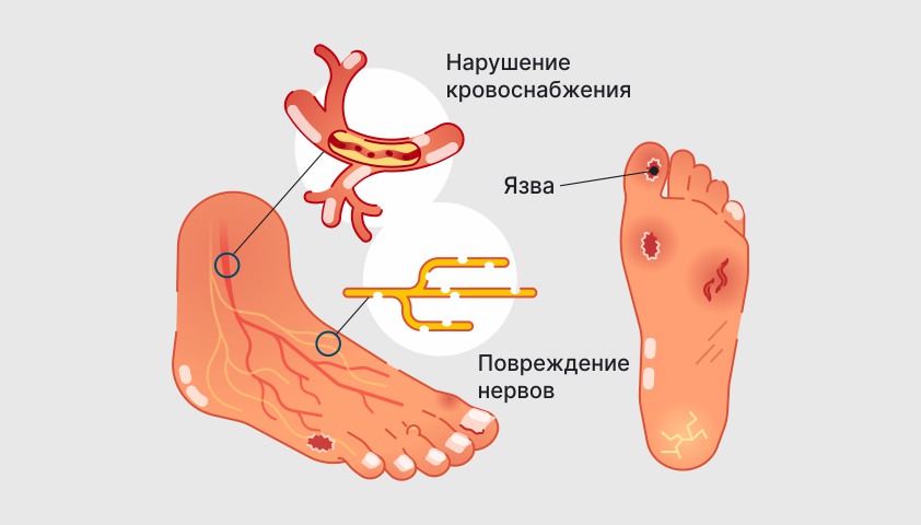 Диабетическая стопа — что такое, фото, симптомы и лечение