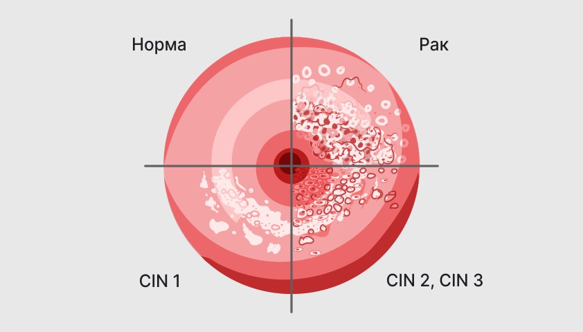 Рак кожи - симптомы, признаки, как выглядит и проявляется