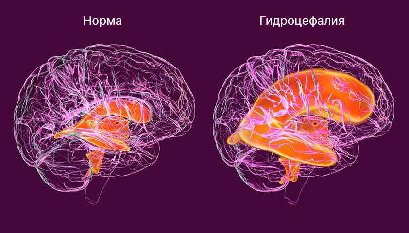 Что такое гидроцефалия головного мозга? Причины гидроцефалии у детей