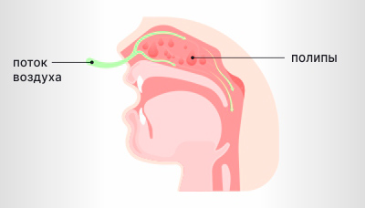 Полипы-в-носу