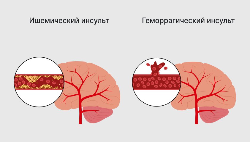 Инсульт