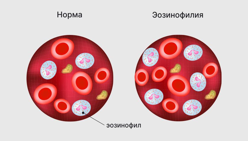 Уровень эозинофилов увеличен у взрослого в крови