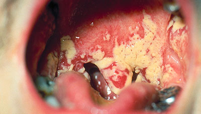 Изображение Псевдомембранозного кандидоза