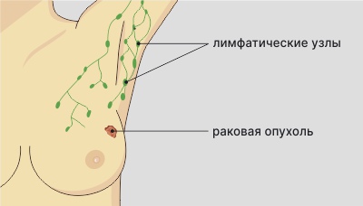 Рак молочной железы