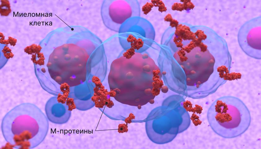 Миеломная болезнь - симптомы, профилактика и лечение