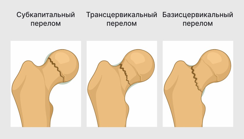 Виды-переломов