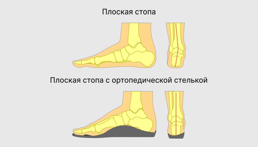 Плоскостопие у взрослых и детей - что это, виды, степени, лечение