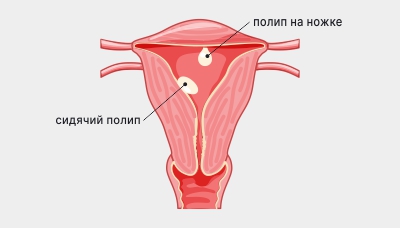 Полипы эндометрия