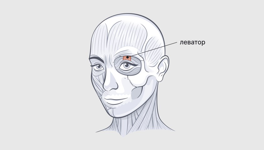 Птоз века — что это такое, причины, диагностика и лечение блефароптоза