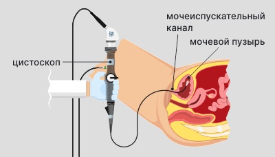 Цистоскопия