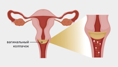 Фото вагинального колпачка