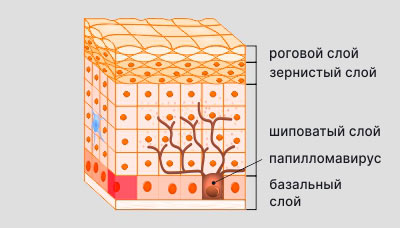 Роговая кератома (кожный рог) - что это, что делать, нужно ли удалять