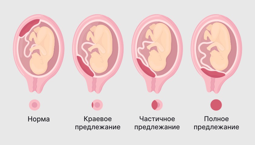 Предлежание плаценты - низкое или полное, причины, что делать