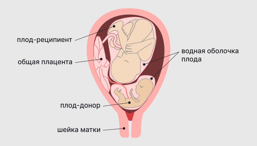 Зеркальный синдром при беременности - что это, причины